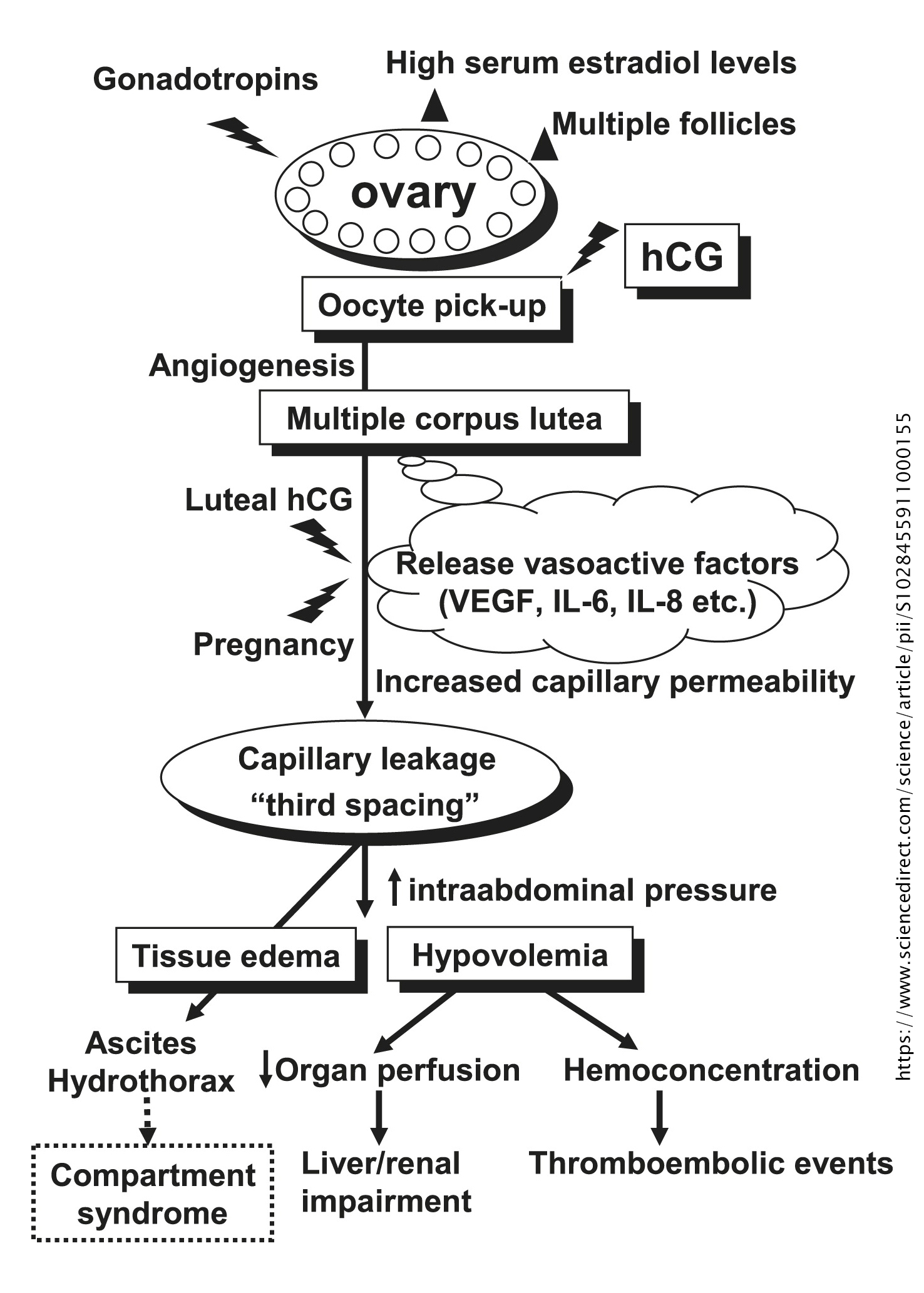 Ovarian Hyperstimulation Syndrome | PaReflectionEd